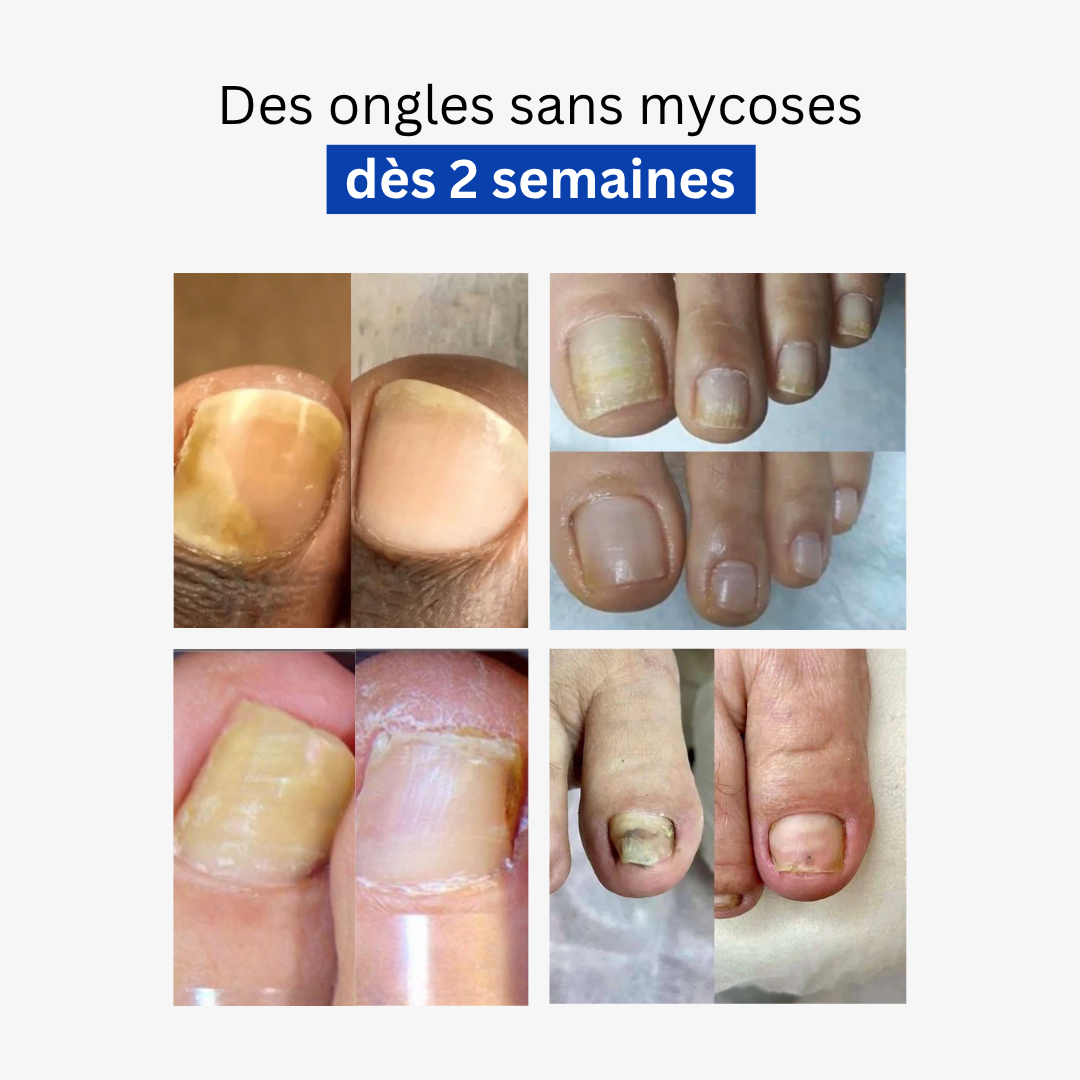 Cure Anti-Mycoses