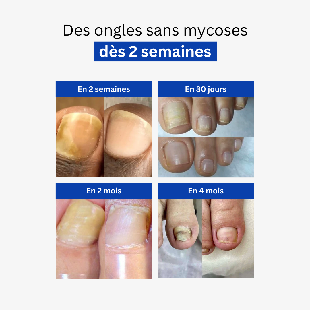 Cure Anti-Mycoses