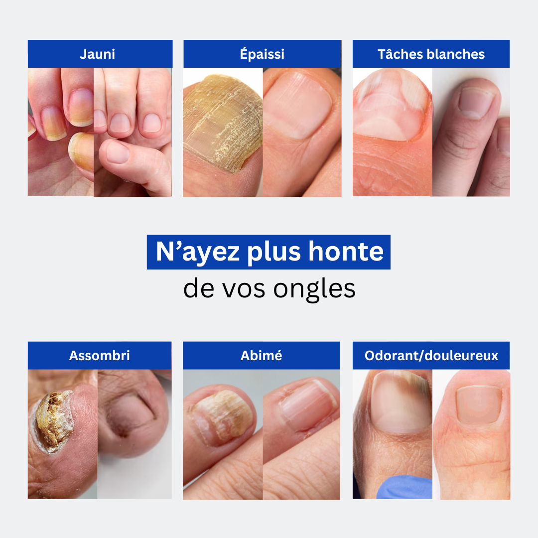 Cure Anti-Mycoses
